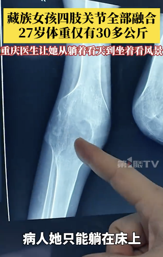 藏族女孩四肢关节全部融合卧床多年