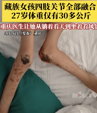 藏族女孩四肢关节全部融合卧床多年