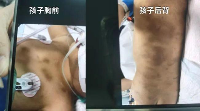 3岁男童被虐待致死案母亲曝光细节 生前多次烈日下罚站