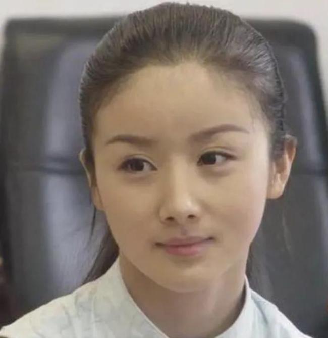 演员孙菲菲回应整容失败 实为库欣式综合征所致