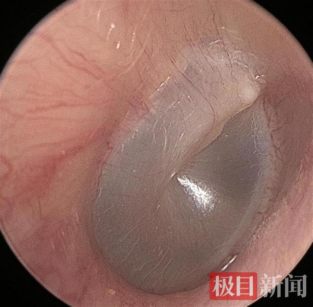 男子和猫同睡耳中长出猫螨虫:米粒大小正在鼓膜上爬行