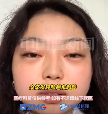 23岁健身女子狂长生长纹确诊库欣病 医生提醒
