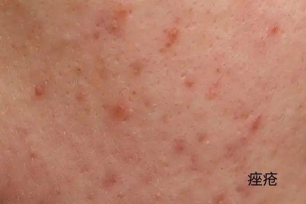几块钱一管的维A酸乳膏，是“护肤圣品”还是致癌毒物？