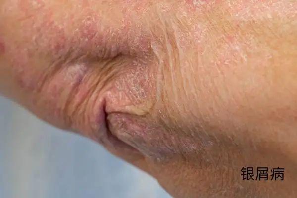 几块钱一管的维A酸乳膏，是“护肤圣品”还是致癌毒物？