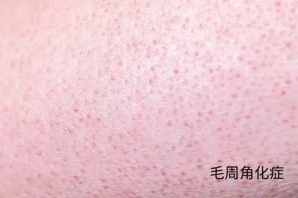 几块钱一管的维A酸乳膏，是“护肤圣品”还是致癌毒物？