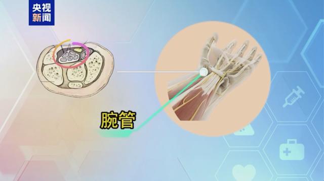 “鼠标手”被纳入职业病！别等肌肉萎缩才重视，医生提醒→