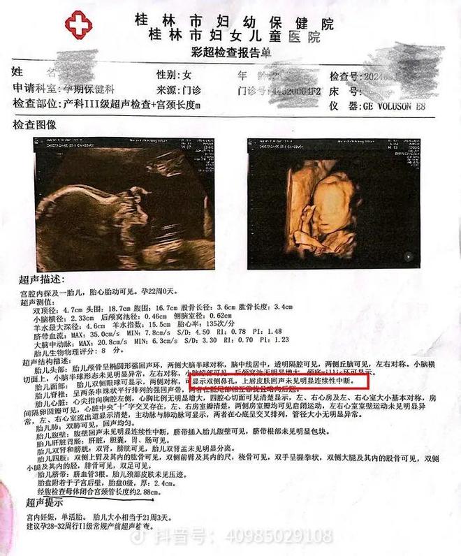 桂林女子称彩超漏诊婴儿唇腭裂，到卫健委反映问题遭怒斥，最新进展：工作人员停职检查，事件仍在处理中